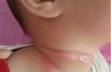 宝宝出现脖子红是怎么回事？