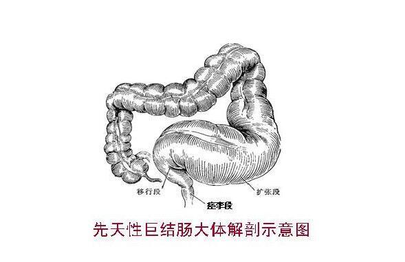 宝宝先天性巨结肠症状是什么