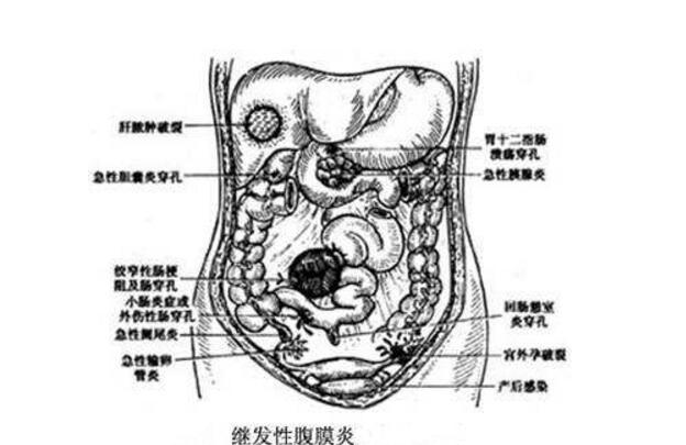 小儿继发性腹膜炎怎么治疗