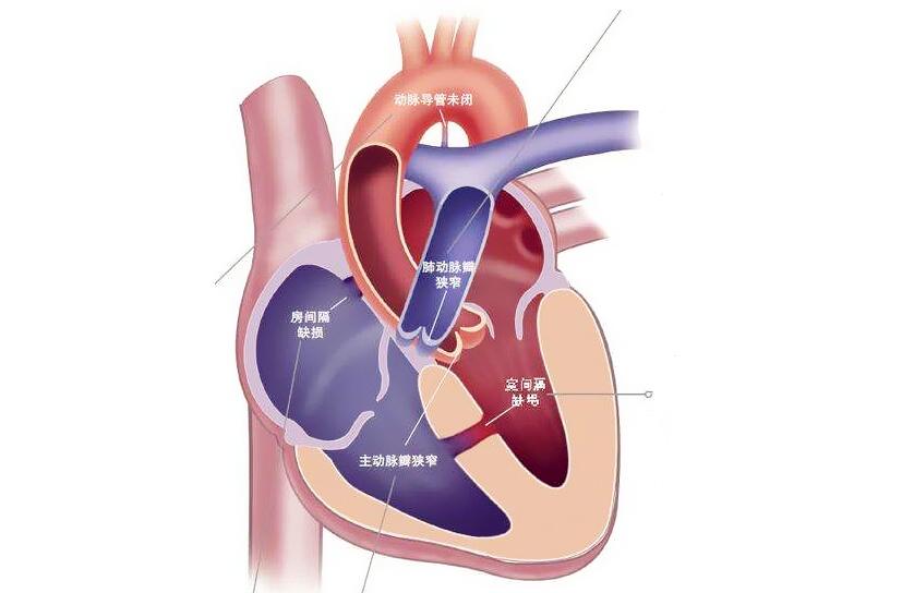 小儿心衰的治疗原则