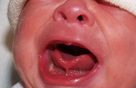 宝宝舌系带过短影响吃奶、说话吗？