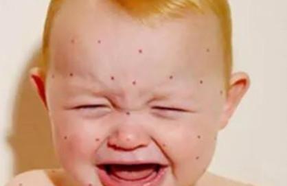 冬天，宝妈们要小心这4种疹子和痘痘！
