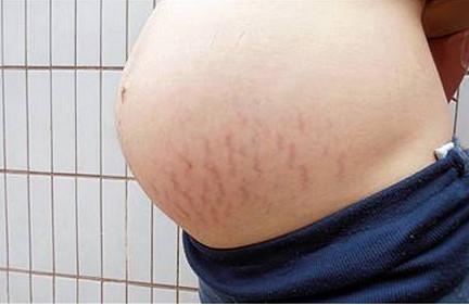 妊娠纹太折磨人？掌握好这三点让你避开它！