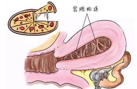 关于宫腔粘连，你知道多少