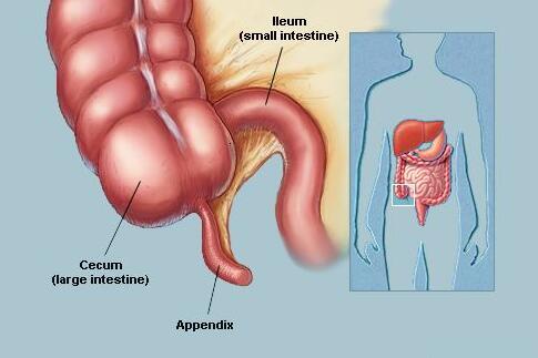 小儿急性阑尾炎怎么预防