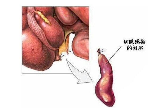 小儿急性阑尾炎手术多少钱