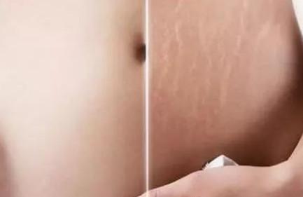 产后怎么消除妊娠纹？3个小偏方，超有效！