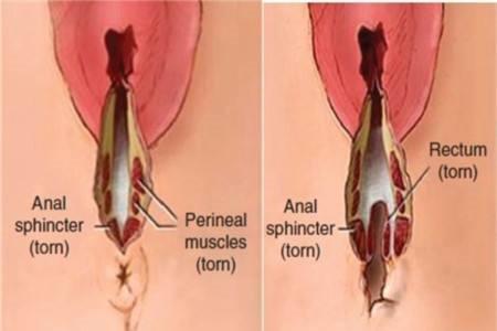 会阴撕裂恢复会痒吗 私处护理很重要