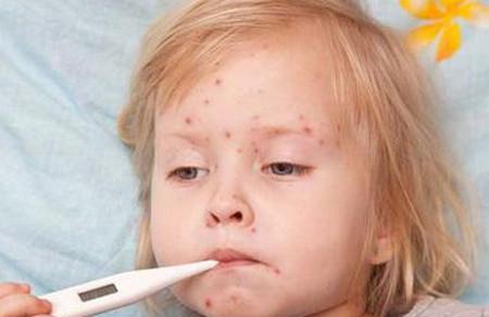 宝宝平时怎样预防水痘的发生？