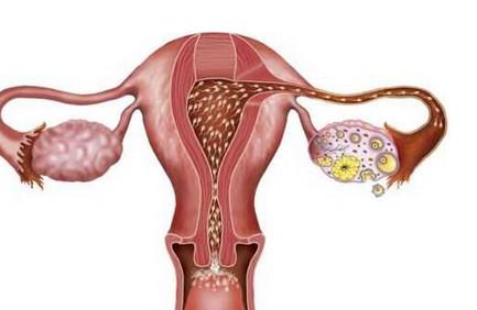 多囊卵巢的这几个并发症，你务必要知道！