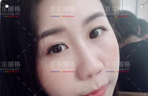 首尔丽格埋线提升 流行的驻颜抗老方式