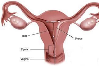 子宫发育不良会怀孕吗 子宫发育不良=不孕吗？