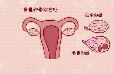 患有多囊卵巢综合征该怎么备孕？这3招你一定要知道！