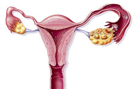 如何精确诊断输卵管性不孕？