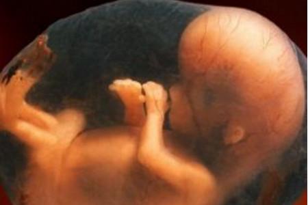 27周胎儿查出“足内翻”，还能要吗？