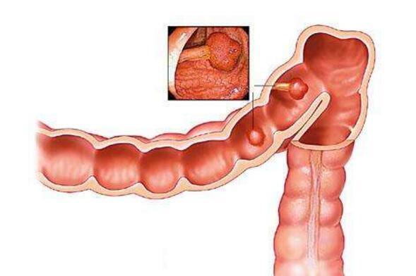小儿肠梗阻有什么症状