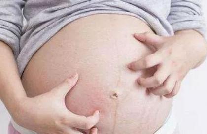 孕妇过敏，会不会遗传给胎儿呢？