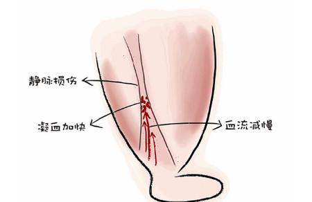 孕期变胖，怪谁？