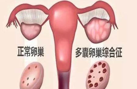 多囊卵巢和多囊卵巢综合征，有哪些区别呢？