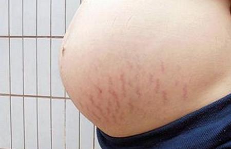为什么有人生孩子，不长妊娠纹呢？