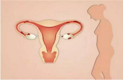 子宫内膜癌通常会发生在哪类女性身上？