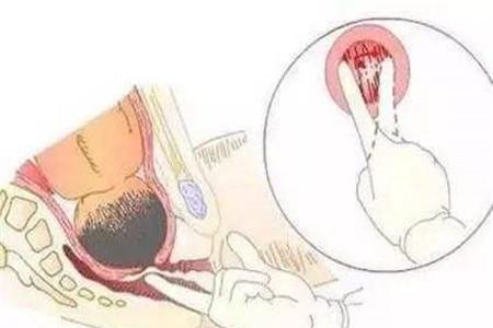 生孩子宫口开几指可以生 这个不能急