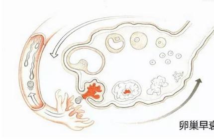 卵巢早衰是女性卵巢性不孕的最大原因！