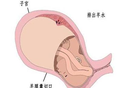 二胎剖腹产一般都会提前吗 不早不晚刚刚好