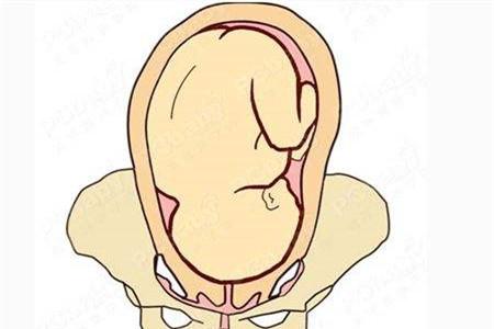 胎儿不入盆宫口会开吗 宫口知识了解下
