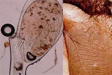 男性得阴虱的症状图片 这些症状一定不能忽略！