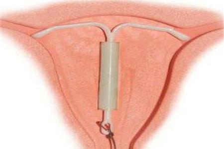 吉妮致美环避孕率怎么样