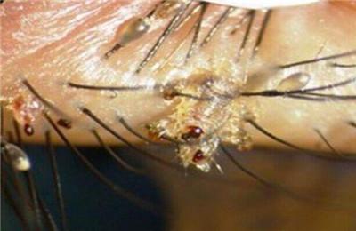 阴虱的虫卵藏在哪里 阴虱卵真的在毛囊里吗？