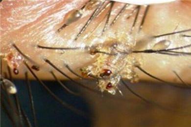 阴虱的虫卵藏在哪里 阴虱卵真的在毛囊里吗？