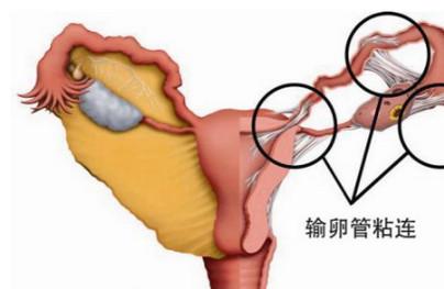 输卵管粘连想怀孕，该怎么办？