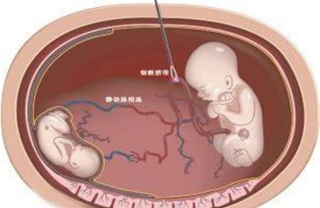 减胎对另一个胎儿有影响吗 减胎知识要了解