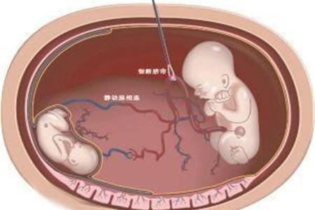 减胎对另一个胎儿有影响吗 减胎知识要了解