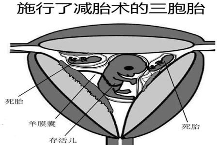 减胎后注意事项有哪些 这些篇章告诉你