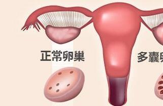 雄性激素偏高是多囊吗 多囊跟雄性激素有什么关系？