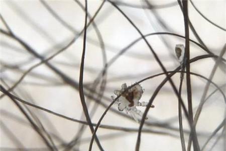 阴虱会乱爬吗 阴虱真的会爬遍全身吗？