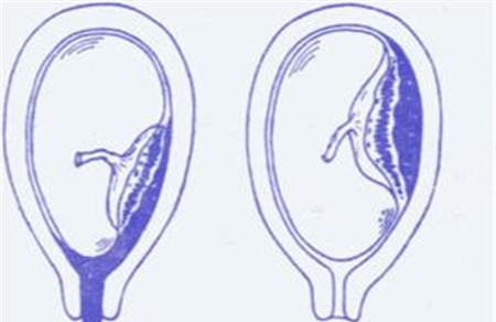 产后胎盘残留的症状 这些表现要注意