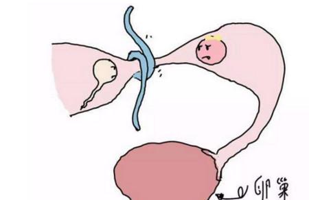 输卵管结扎避孕后反悔了，还能要孩子吗？