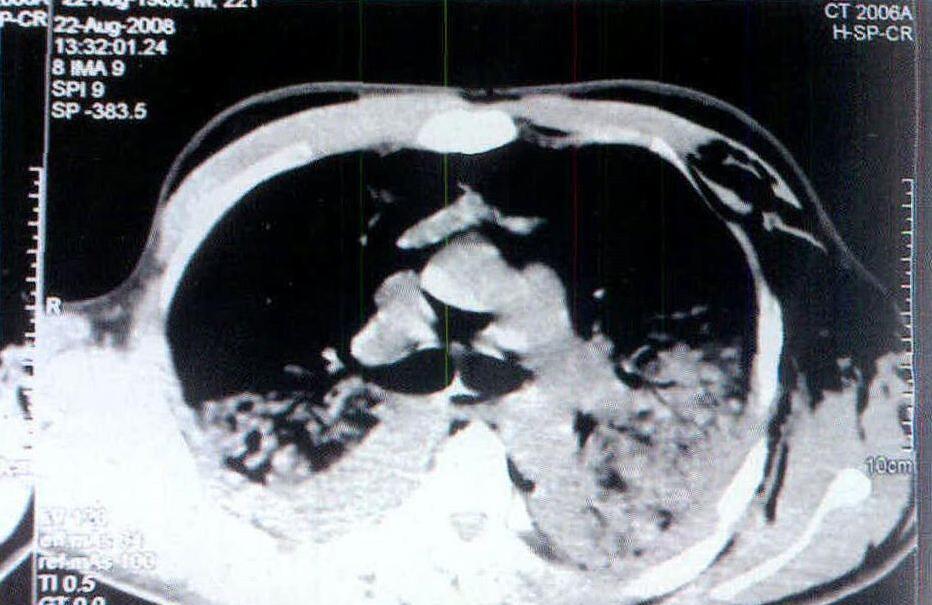新生儿湿肺是什么引起的