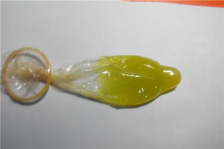 精子果冻状能自愈吗 精子果冻状可以不治疗吗？