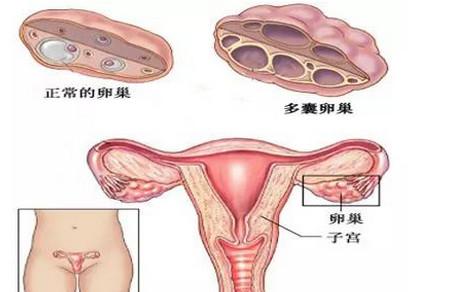你真的了解多囊卵巢综合征吗？