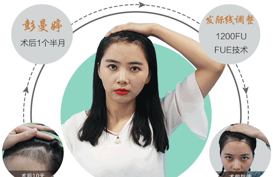 深圳青逸植发医院植发效果怎么样 诚信高质诊疗