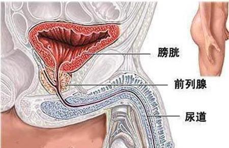 前列腺钙化影响怀孕吗 前列腺钙化不能生孩子吗？