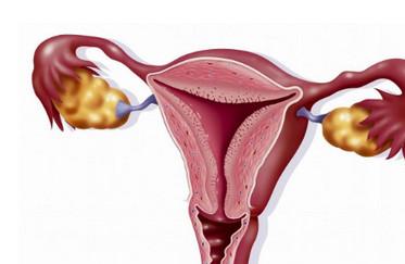 多囊卵巢综合征患者，有必要运动减肥吗？