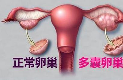多囊备孕，你遇到这些问题没？