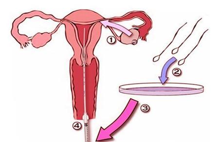人工授精一般几次成功 放缓心态最重要