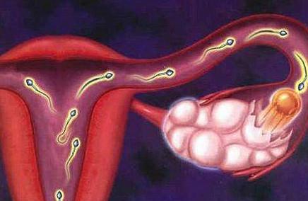 多囊卵巢综合症是遗传的吗？